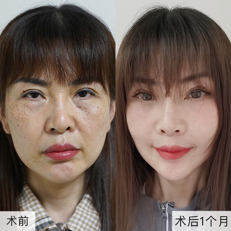 Cheek Lift Surgery
